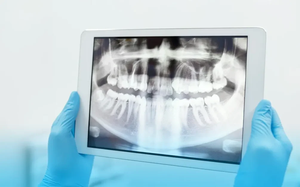 morbo di mordida e sindrome dell'articolazione ipermobile